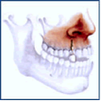 dental implant incisor