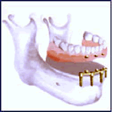 removal denture